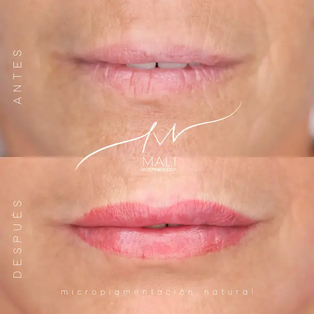 Antes y después: labios naturales